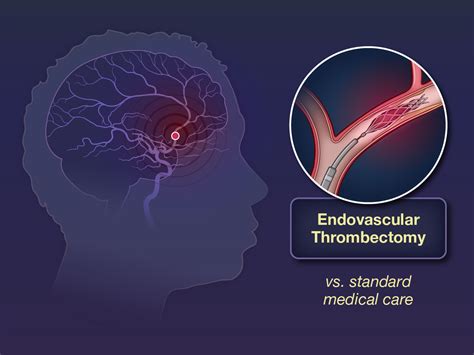 Trial of Endovascular Thrombectomy for Large Ischemic Strokes